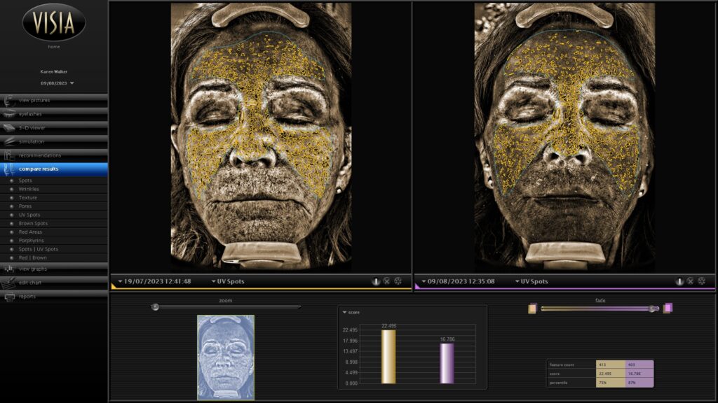 UV spot reduction with Prager facials