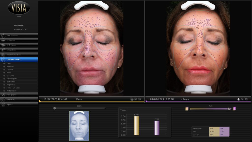 Open pores reduction with Prager facials