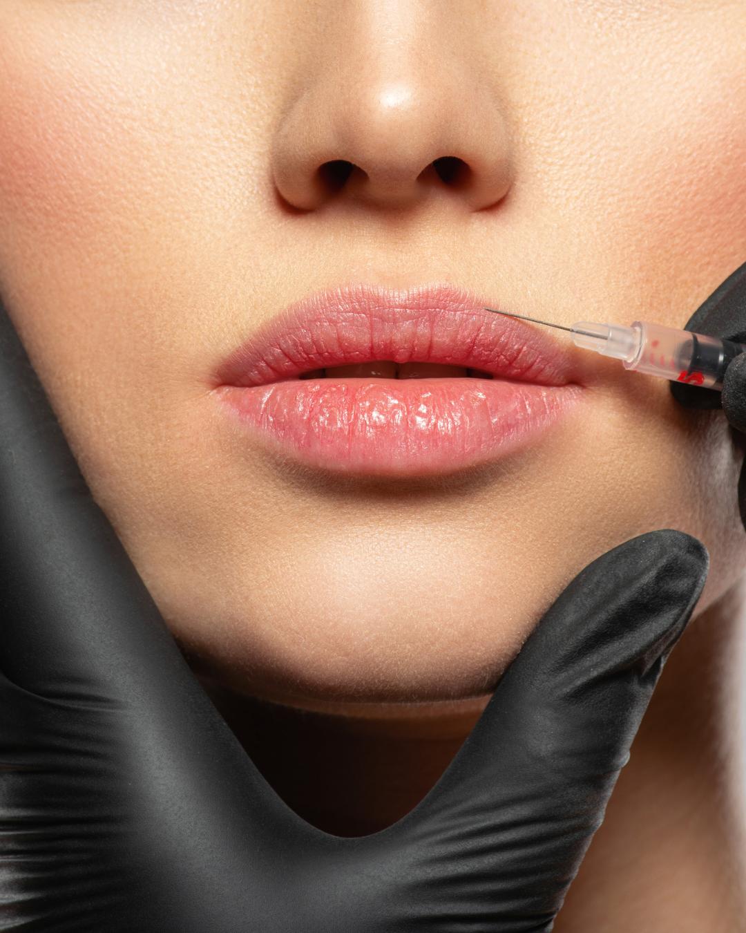 Dermal fillers are a great anti-ageing treatment